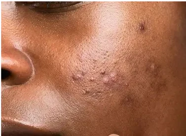 ACNE & DARK SPOTS
