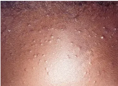 CLOGGED PORES