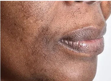UNEVEN SKIN TONE