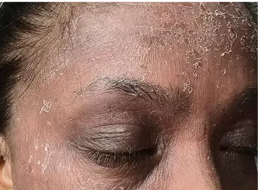 DRY, PATCHY SKIN